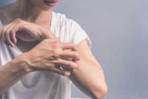 A woman with psoriasis scratching her arm