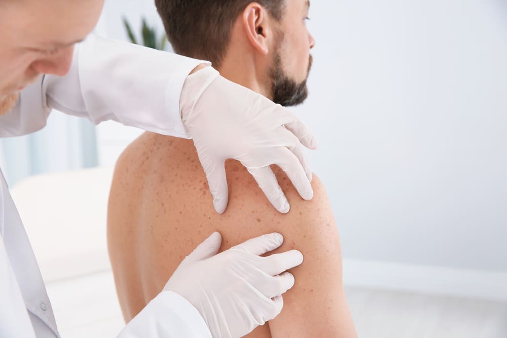 Doctor examines a mole during a skin cancer screening