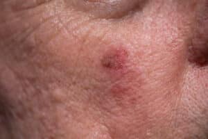 An actinic keratosis under the eye of an elderly man