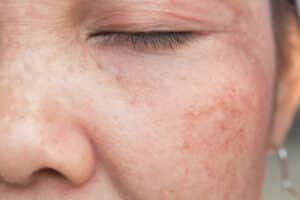 Close up image of an older woman with Melasma, or brown spots.
