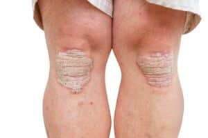 Woman's knees, showing scaly psoriasis plaques